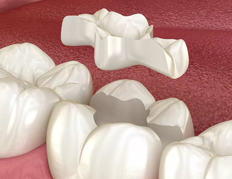 新浦安（浦安市）の歯医者の審美歯科治療