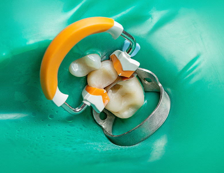 新浦安（浦安市）の歯医者でむし歯治療