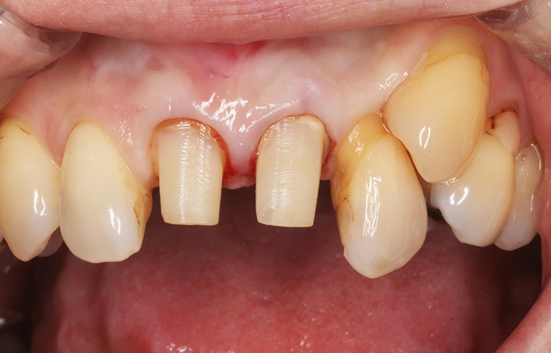 新浦安(浦安市)の歯医者の審美歯科