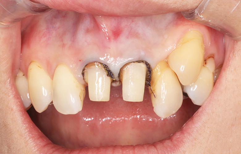 新浦安(浦安市)の歯医者の審美歯科