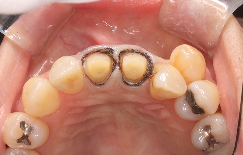新浦安(浦安市)の歯医者の審美歯科