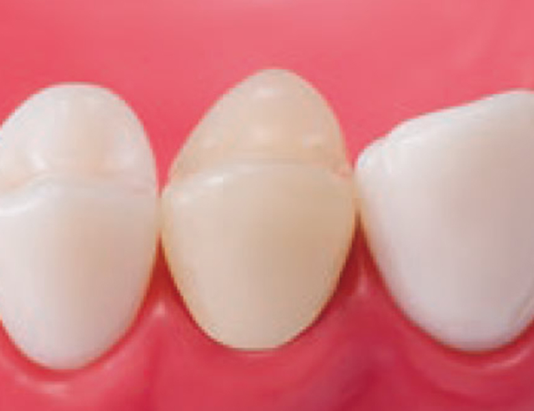 新浦安（浦安市）の歯医者の審美歯科治療