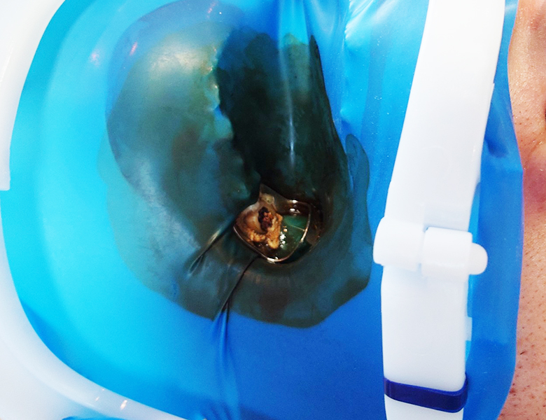 新浦安(浦安市)の歯医者でラバーダム