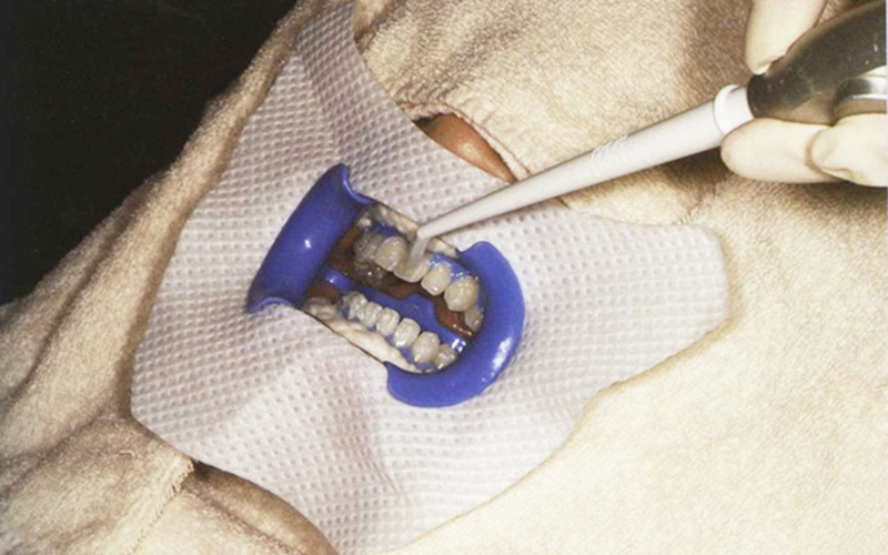 新浦安(浦安市)の歯医者の審美歯科