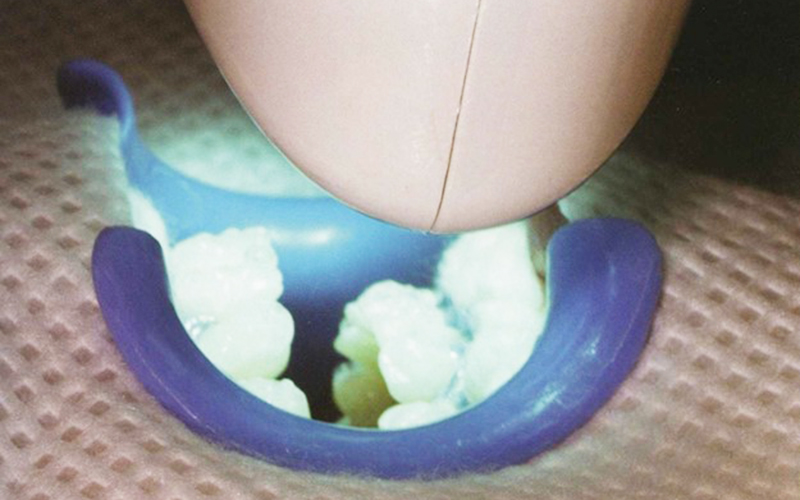 新浦安(浦安市)の歯医者の審美歯科